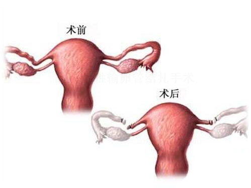 女性结扎恢复的手术过程,女性结扎的手术流程