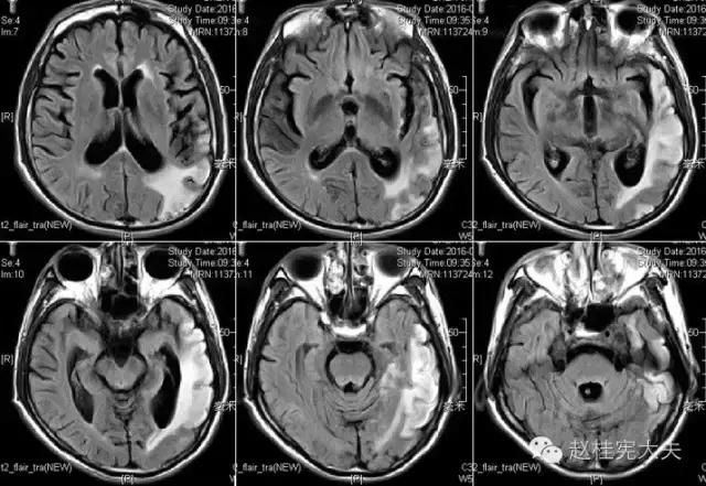 脑卒中简单科普,年轻人是不是不要担心脑卒中
