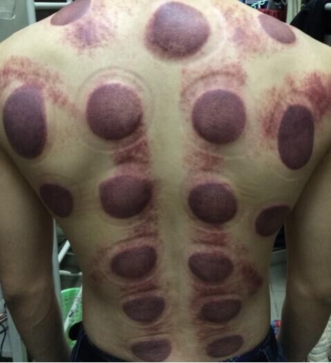 拔罐罐印分析图解,拔罐时出现罐印红是怎么回事