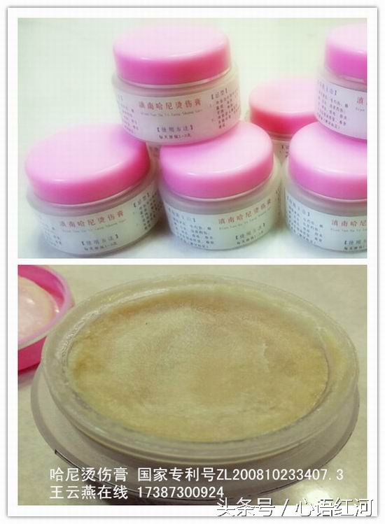 张祥英亲历：右臂三度烧伤28天治愈不植皮