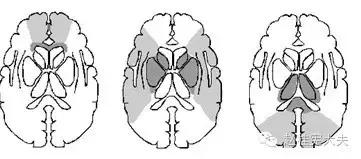 脑卒中简单科普,年轻人是不是不要担心脑卒中