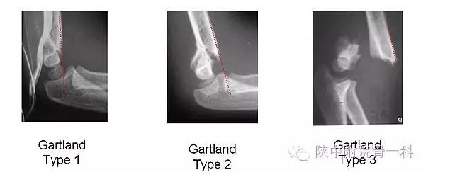 肱骨髁上骨折闭合复位手术记录,小儿肱骨髁上骨折手术恢复的概率