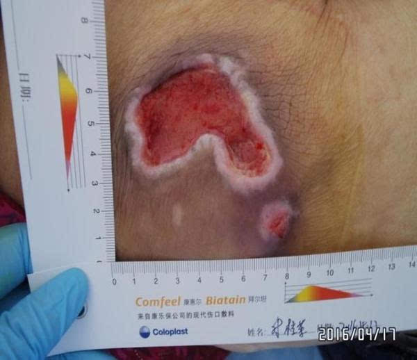 老人长期卧床皮肤有破皮,长期卧床导致皮肤破溃用什么药