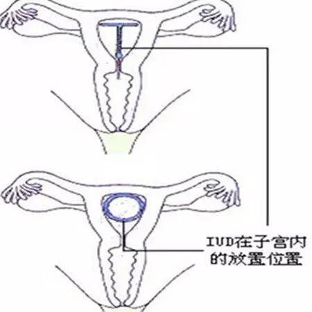 男人，如果你爱你的女人，就别让她上环！