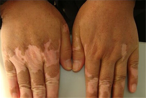 得了白癜风怎么办4个方法有奇效,得了白癜风怎么治好得快