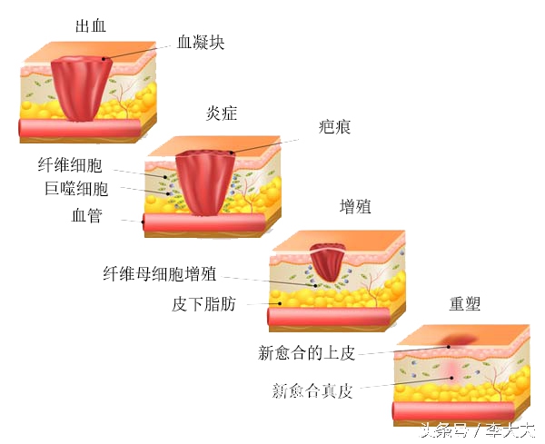 皮肤伤口增生,皮肤伤口愈合后反复长角质