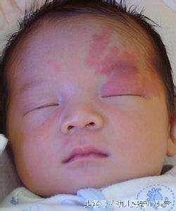 为什么有些婴儿会有胎记,为什么有的婴儿会有胎记