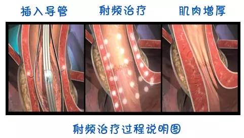 食管反流吃什么药可彻底治愈,胃食管反流病的四个典型症状