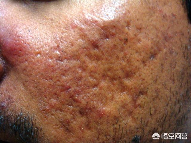 痘痘是有基因原因吗,遗传痘痘能彻底治愈吗