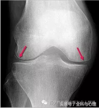 软组织钙化与骨化,软组织钙化和骨质增生