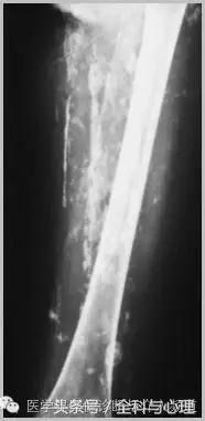 软组织钙化与骨化,软组织钙化和骨质增生