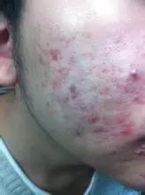 宝宝脸上痘痘有白色脓包,脸上长脓包痘痘怎么办