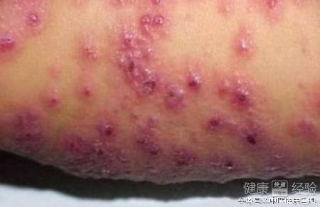 湿疹中医辨证,湿疹性皮炎中医辨证