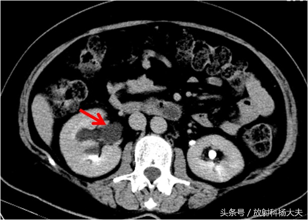 老人检查出肾积水,女老人肾积水怎么治最好