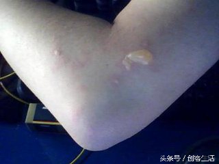 烫伤了不能干什么,烫伤一直火辣辣的疼用牙膏可以吗