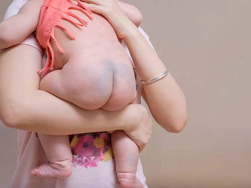 小孩青色胎记会自行消退吗,胎记哪种可以慢慢淡去