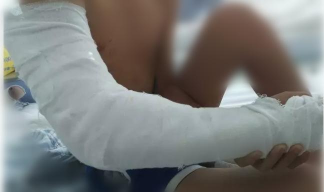 肱骨髁上骨折闭合复位手术记录,小儿肱骨髁上骨折手术恢复的概率