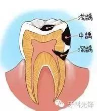 一般多长时间洗一次牙比较合适,牙到底洗还是不洗好