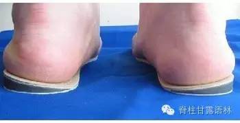 治疗膝关节痛的单方中医秘方,膝关节软骨瘤保守治疗