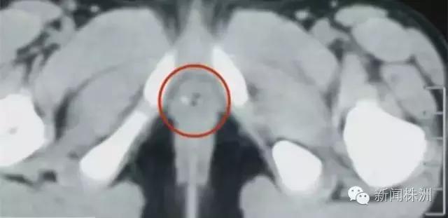 7岁女童沙坑玩出妇科炎症？！