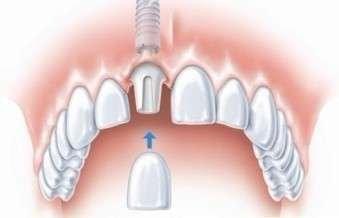 科普种牙常识大全,种植牙知识科普一次种植终身无忧