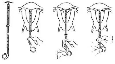 安了环还怀孕！怨我喽？