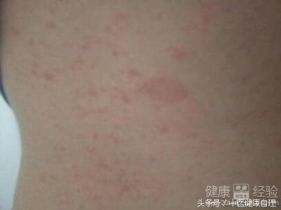 湿疹中医辨证,湿疹性皮炎中医辨证