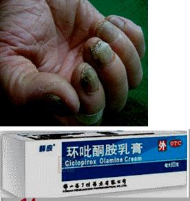 脚气灰指甲医生推荐的药膏,治疗脚气真菌灰指甲的草药