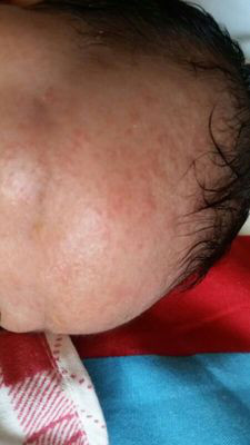 宝宝湿疹怎么治能除根,蓓氏婴儿奶癣湿疹膏有激素吗