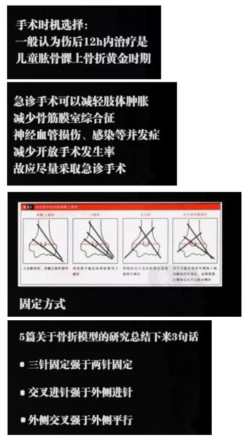 肱骨髁上骨折闭合复位手术记录,小儿肱骨髁上骨折手术恢复的概率