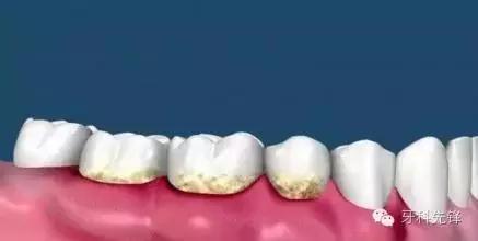 一般多长时间洗一次牙比较合适,牙到底洗还是不洗好