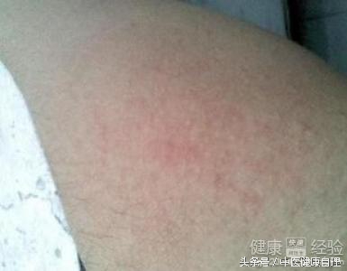 湿疹中医辨证,湿疹性皮炎中医辨证