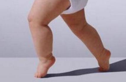 宝宝腿型不直先别急着去纠正，看看医生怎么说