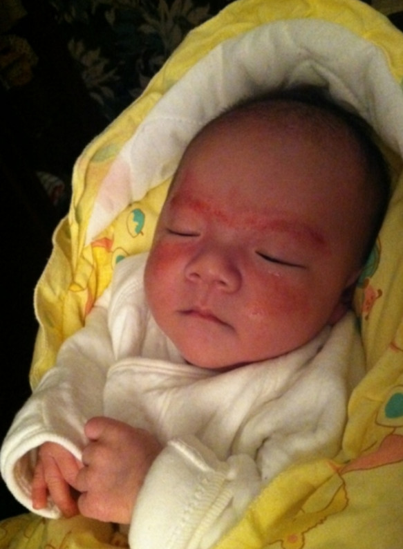 宝宝湿疹怎么治能除根,蓓氏婴儿奶癣湿疹膏有激素吗