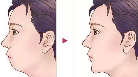 牙齿矫正跟颧骨有什么关系,牙齿矫正和凸嘴的区别