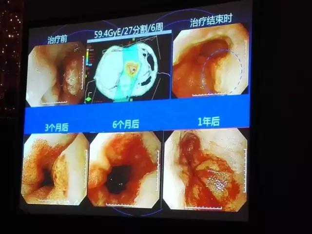 癌症复发转移还可以做质子治疗吗,质子治疗后复发可以用质子治疗吗