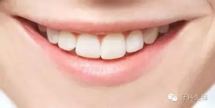 一般多长时间洗一次牙比较合适,牙到底洗还是不洗好