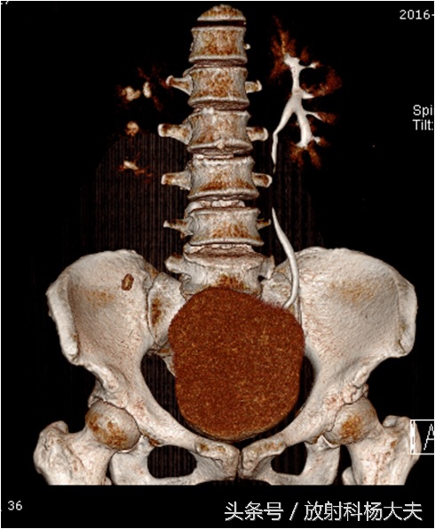 老人检查出肾积水,女老人肾积水怎么治最好