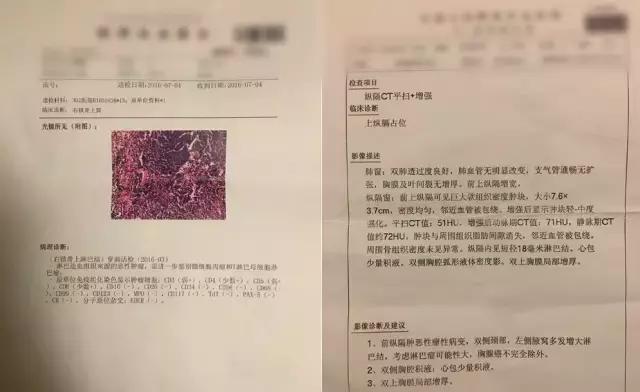 早期淋巴癌治好一般能活多久,淋巴癌发展了一般能活多久