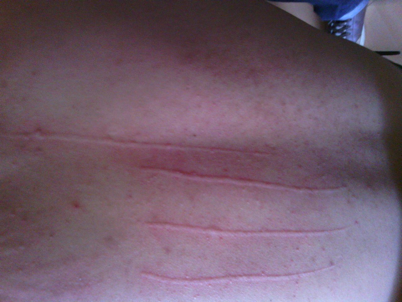 麻疹和荨麻疹的区别是什么,荨麻疹与湿疹的症状有什么区别