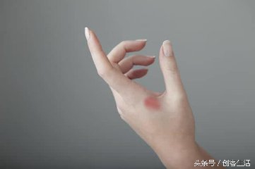 烫伤了不能干什么,烫伤一直火辣辣的疼用牙膏可以吗