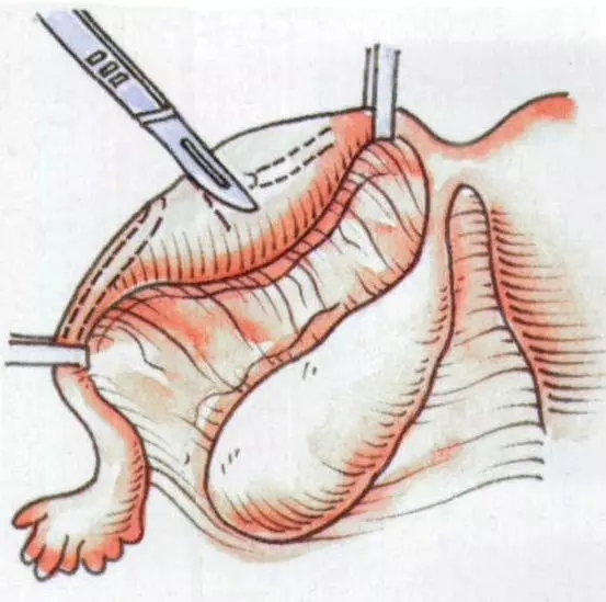 女性二胎后做结扎有影响吗,二胎结扎后想生三胎