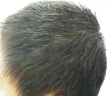 少白头变黑教程,14岁少白头吃什么能变黑