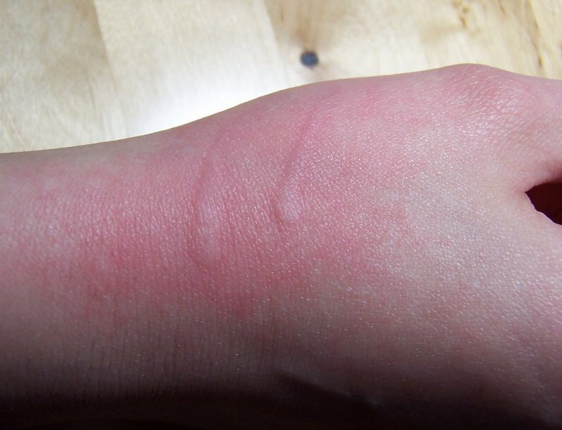 不小心被自家的狗狗咬了一口,不小心被狗狗咬手