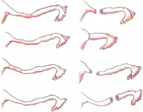 女性二胎后做结扎有影响吗,二胎结扎后想生三胎