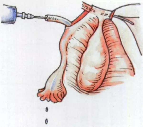 女性二胎后做结扎有影响吗,二胎结扎后想生三胎