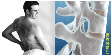 骨质增生怎么根治才最好啊,20多岁骨质增生