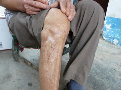 中医治疗精索静脉曲张药方,下肢静脉曲张的中西医治疗