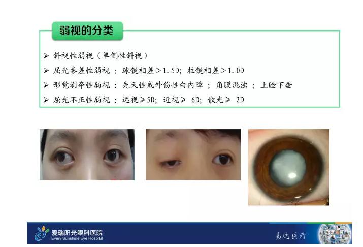 小孩眼睛弱视的最佳治疗时间,小孩子眼睛弱视怎么治疗