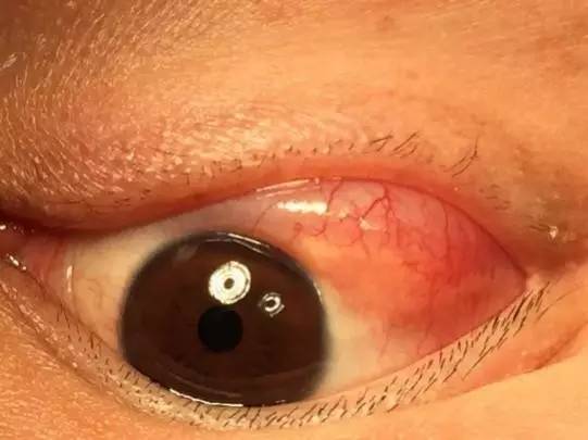 眼球白色边缘有一个囊肿怎么治疗,眼球结膜囊肿如何自己排脓